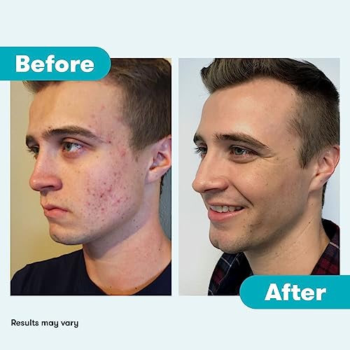 Proactiv 3 Step Acne Treatment - Benzoyl Peroxide Face Wash, Repairing Acne Spot - AB Mystery