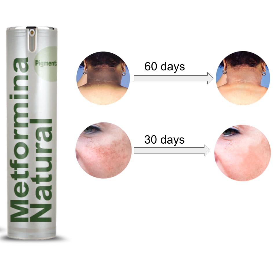 Ni una dieta más METFORMINA NATURAL - Cream for Dark Spots on Face and Body - AB Mystery